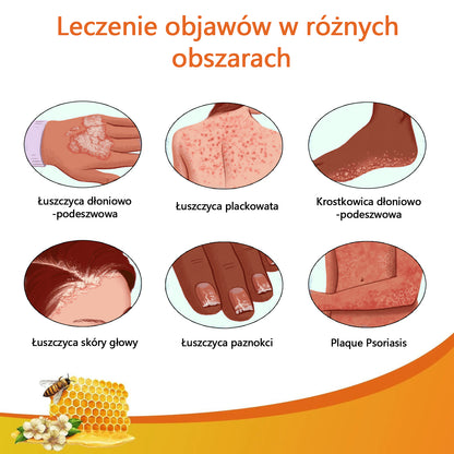 🐝Youth® Bees Venom Psoriasis Treatment Cream-2023 (odpowiedni dla wszystkich chorób skóry)